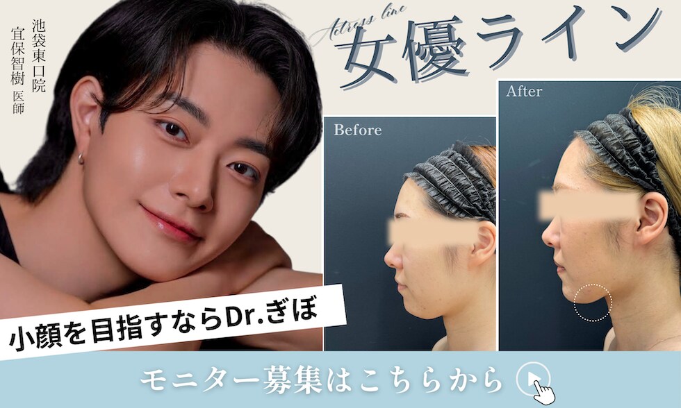 糸リフト