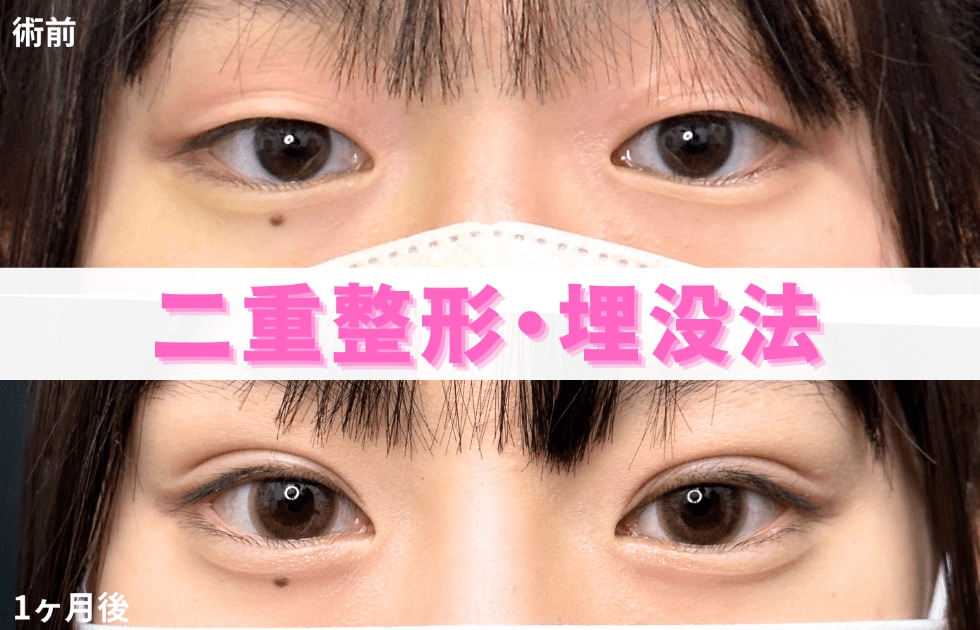 二重症例