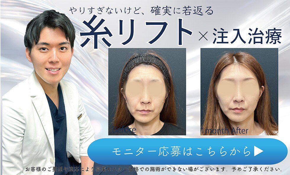 糸リフト