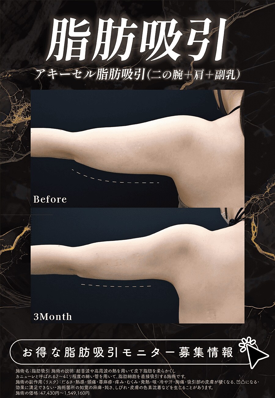 脂肪吸引