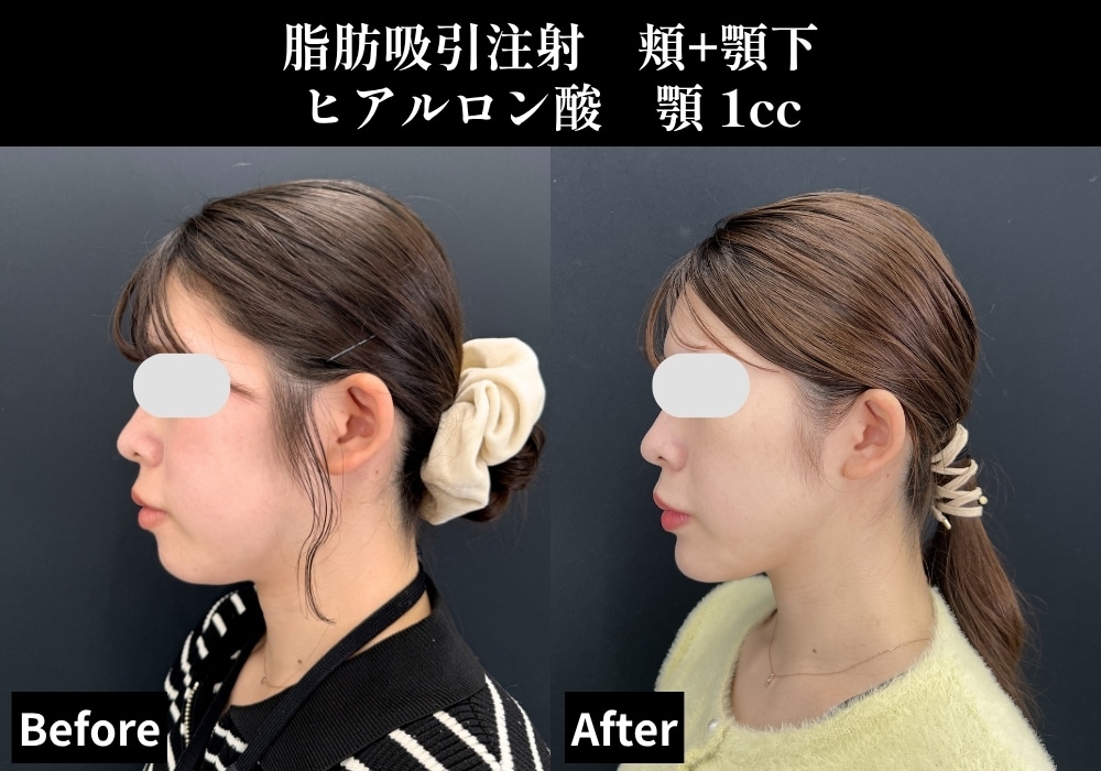 脂肪吸引の症例写真