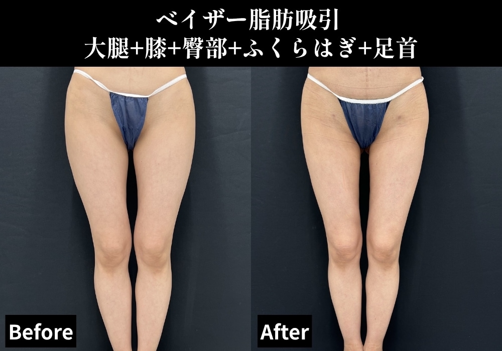 脂肪吸引の症例写真