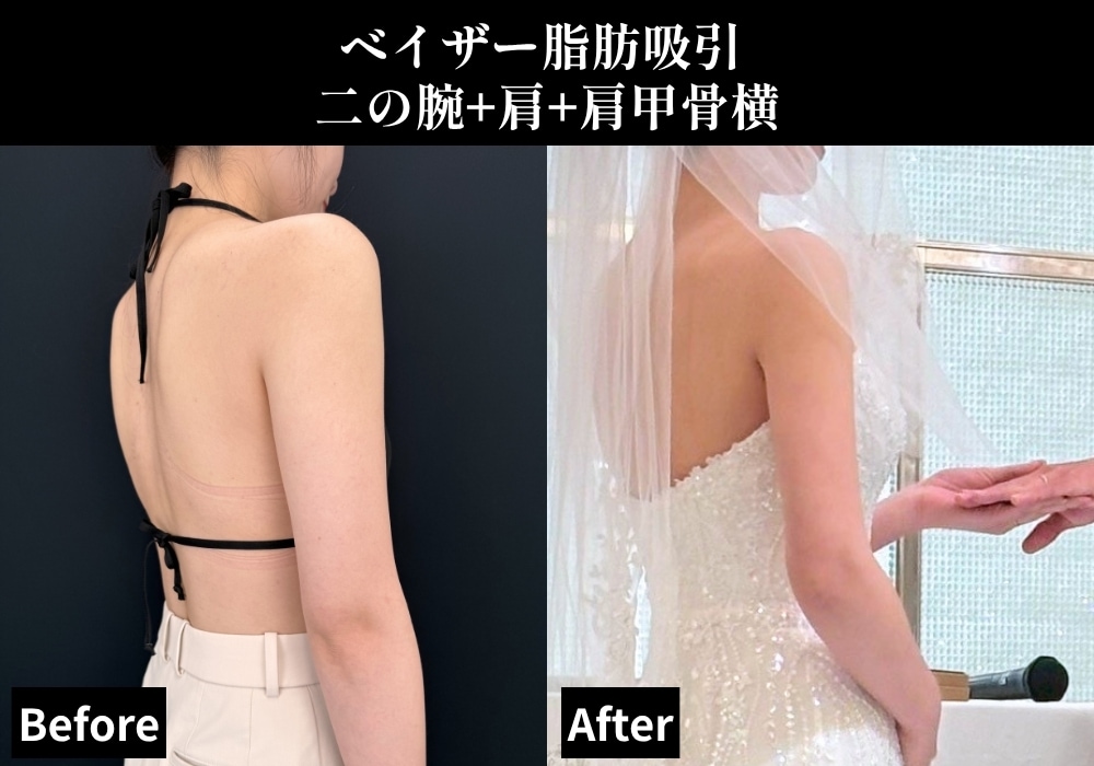 脂肪吸引の症例写真