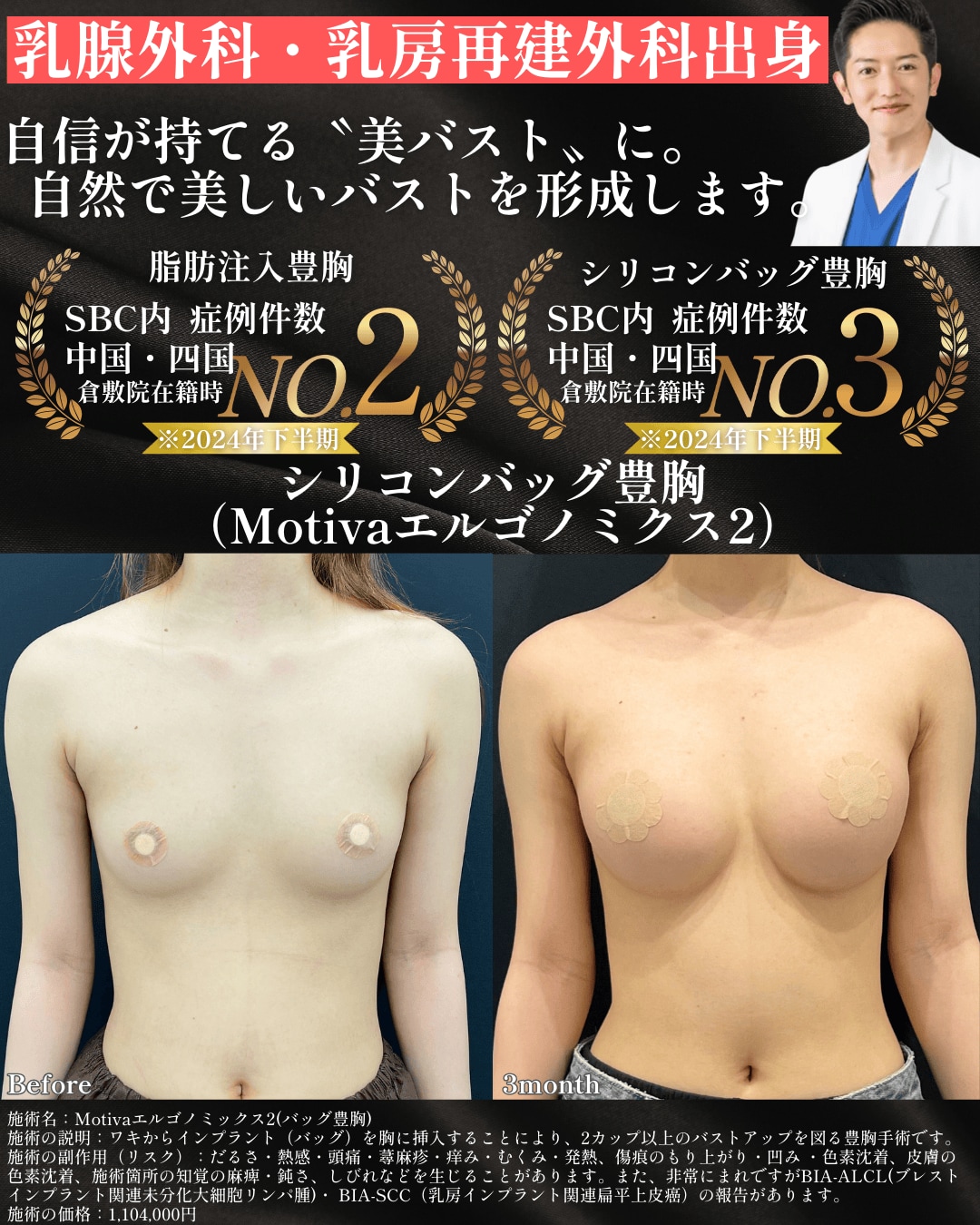 豊胸