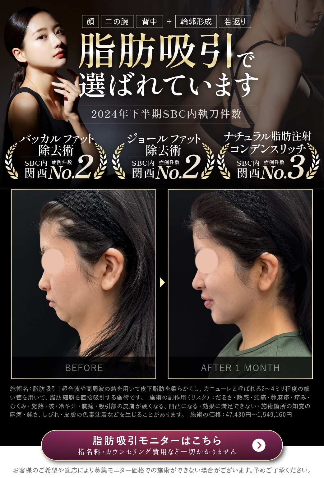 脂肪吸引で選ばれています