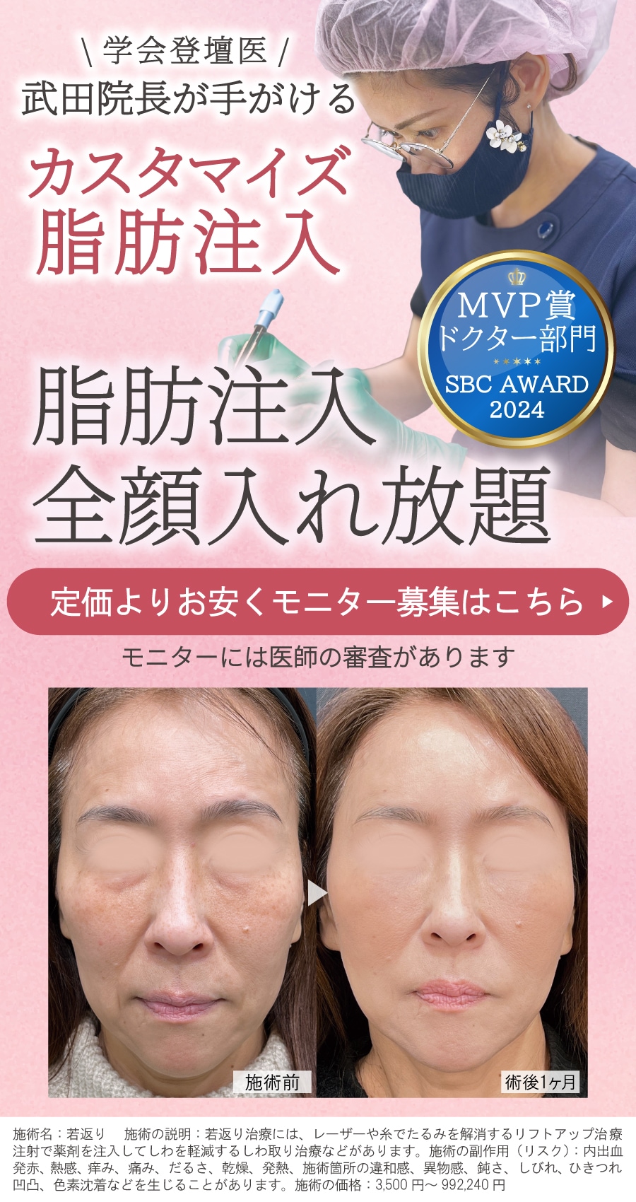 脂肪注入全顔入れ放題