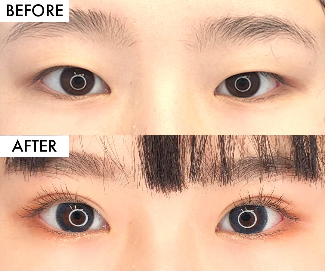 糸リフトの症例写真