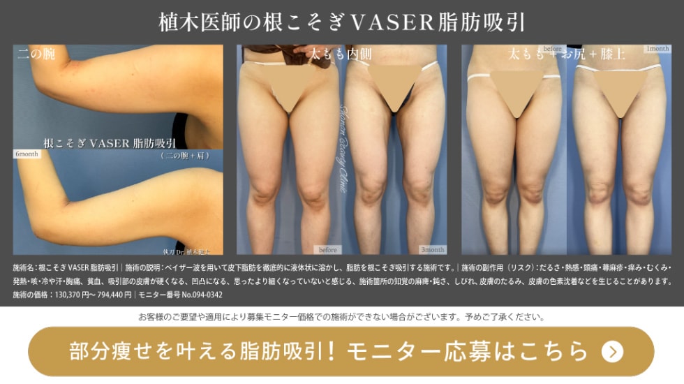 脂肪吸引_体_モニター