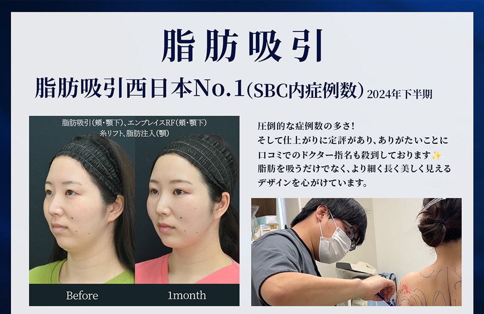脂肪吸引