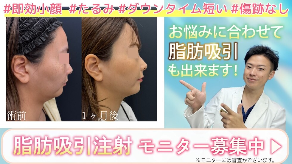 脂肪吸引モニター応募はこちら