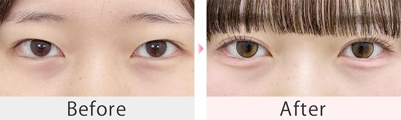 全切開法二重術