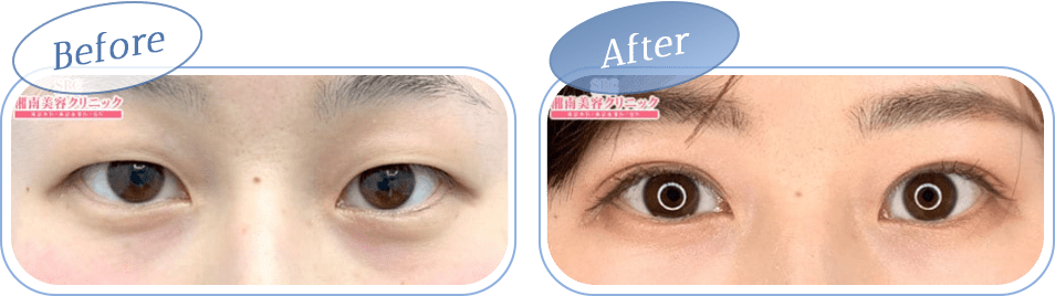自然癒着セット（まぶたの脂肪取り）＋埋没法の症例①
