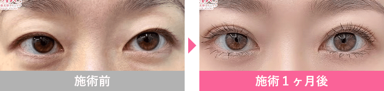 週末二重&reg;の症例写真2