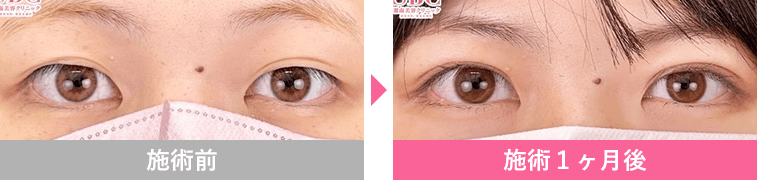 週末二重&reg;の症例写真1