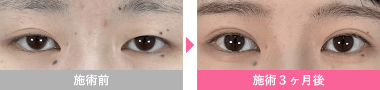 週末二重&reg;の症例写真4