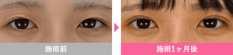 週末二重&reg;の症例写真3