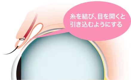 糸を結び、目を開くと引き込むようにする