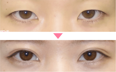 蒙古ひだ・目頭切開プレミアムの症例写真2 ビフォーアフター