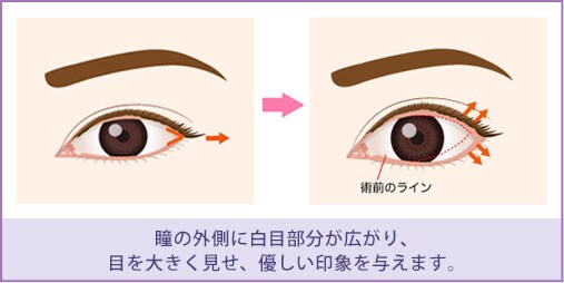 目尻切開の効果