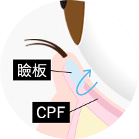 下眼瞼下制 (糸によるタッキング法)step2