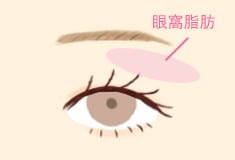 腫れぼったさの原因である「眼窩脂肪」が眼球周囲をかぶっている状態。