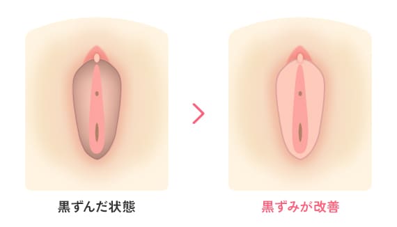 黒ずんだ状態→黒ずみが改善