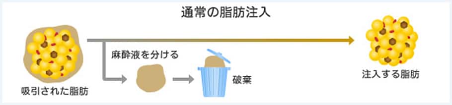 通常の脂肪注入