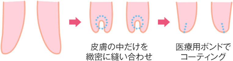 小陰唇の断面図と、7days小陰唇縮小手術のイメージ