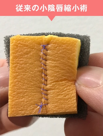 従来の小陰唇縮小術