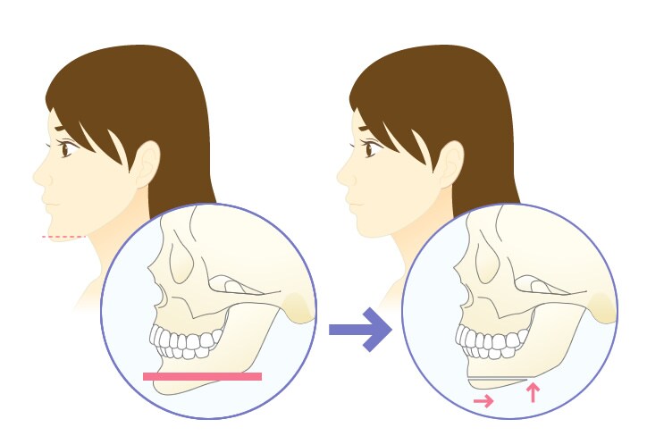 アゴの長さが気になる場合