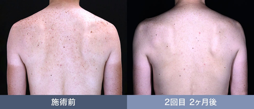 体のシミ取り放題 症例写真