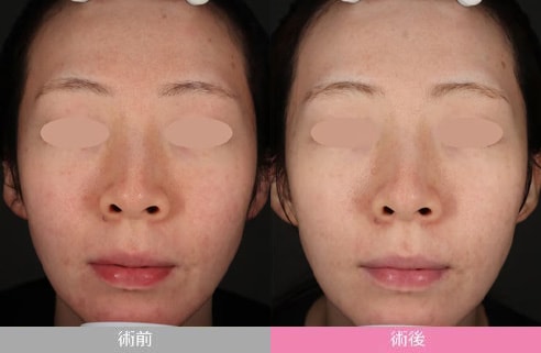 IPL光治療（フォトダブル&reg;）症例写真
