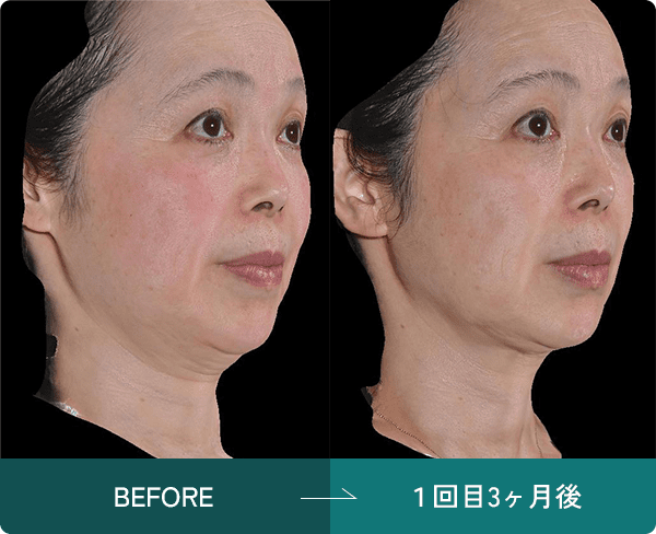 症例写真1