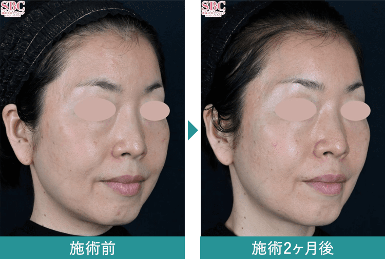 デンシティ 症例写真Before After