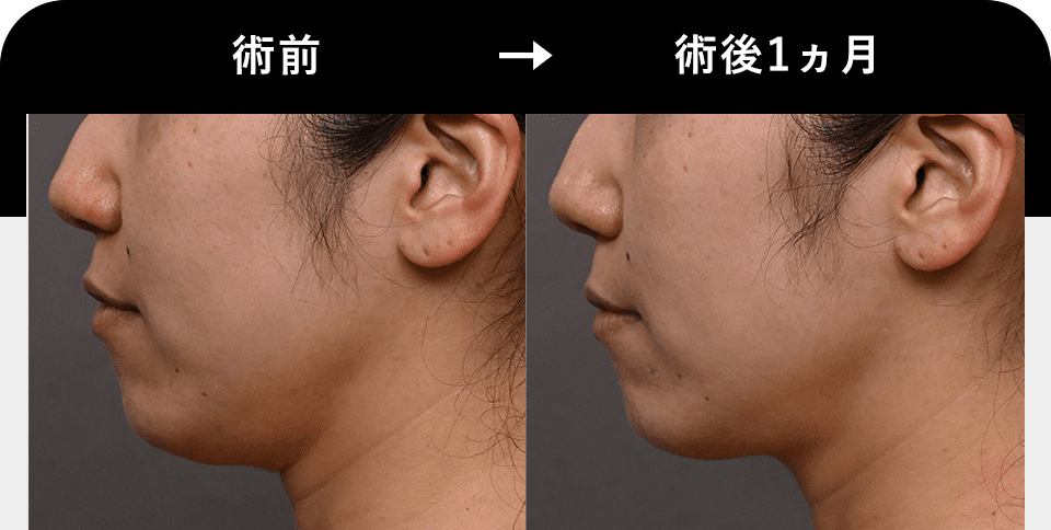 Before After