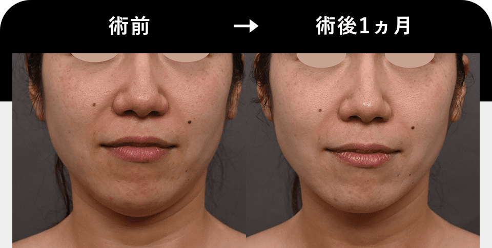 Before After