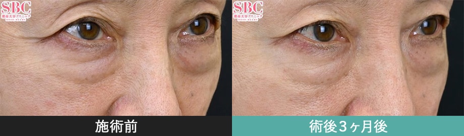 モフィウス8 症例写真 正面