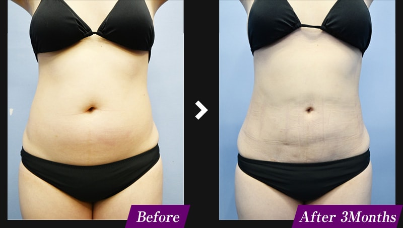 エンブレイスRF（フェイスタイト/ボディタイト）　腹部の症例写真　before after