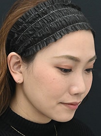 顔の脂肪吸引 症例写真　アフター2