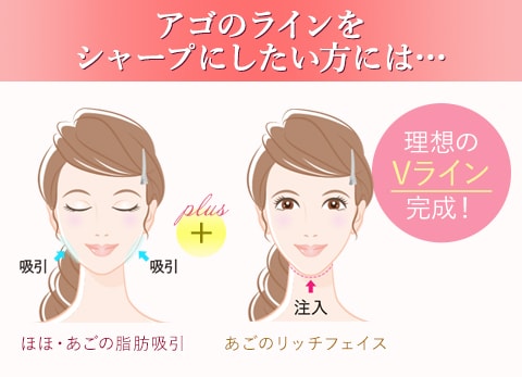 アゴのラインをシャープにしたい方には 理想のVライン完成!