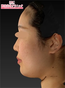 新・脂肪溶解リニアハイフ 症例写真 術前