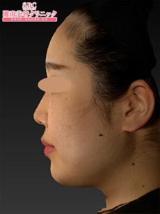 新・脂肪溶解リニアハイフ 症例写真 術後