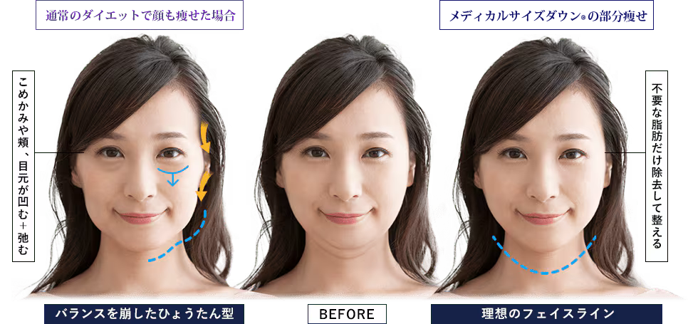 通常のダイエットとメディカルサイズダウン&reg;の顔痩せの比較