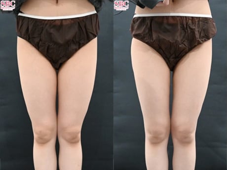 太もも　メディカルサイズダウン&reg;　症例写真