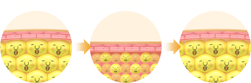 太るメカニズム：脂肪細胞の肥大化