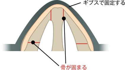 施術方法（ギプス固定）
