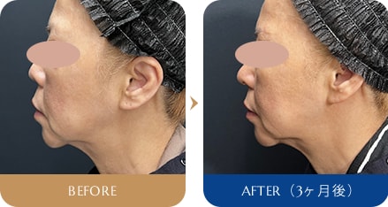 岩間 晋 医師 鼻尖形成3D術／鼻尖部軟骨移植 症例写真1