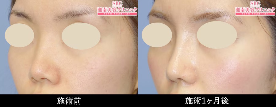 鼻フルプラン症例写真