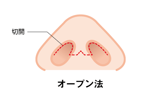 アプローチ法1