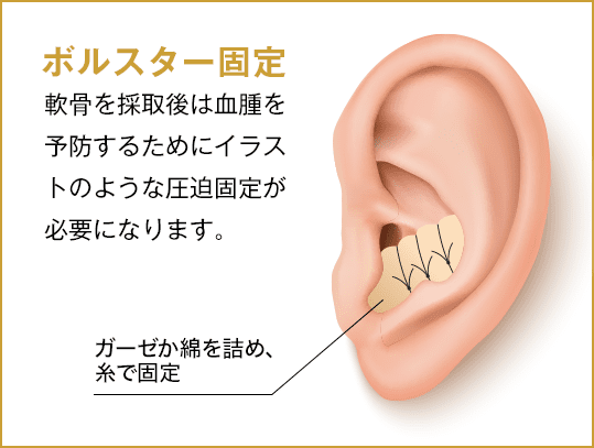 耳介軟骨